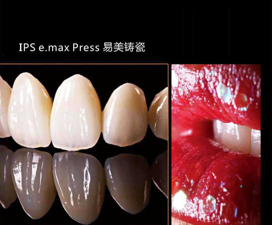 IPS e.max Press易美铸瓷